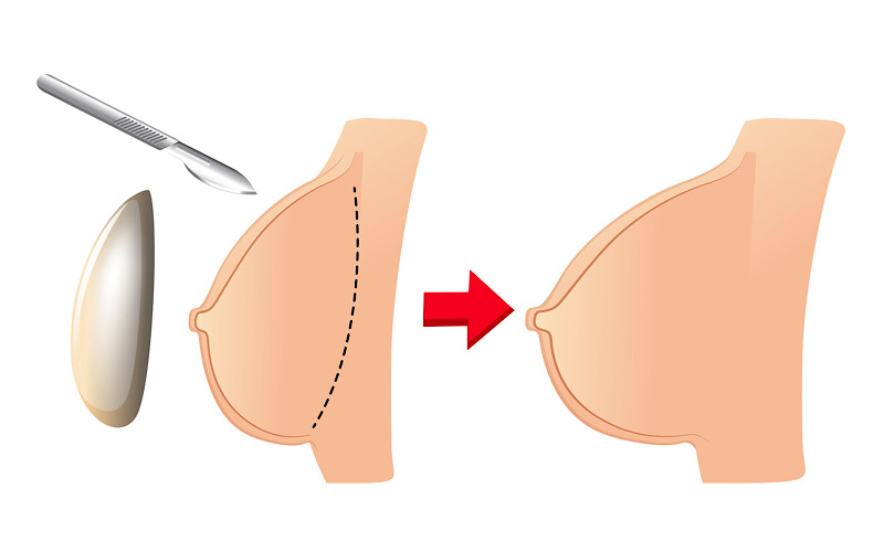 مزایای عمل جراحی پروتز سینه